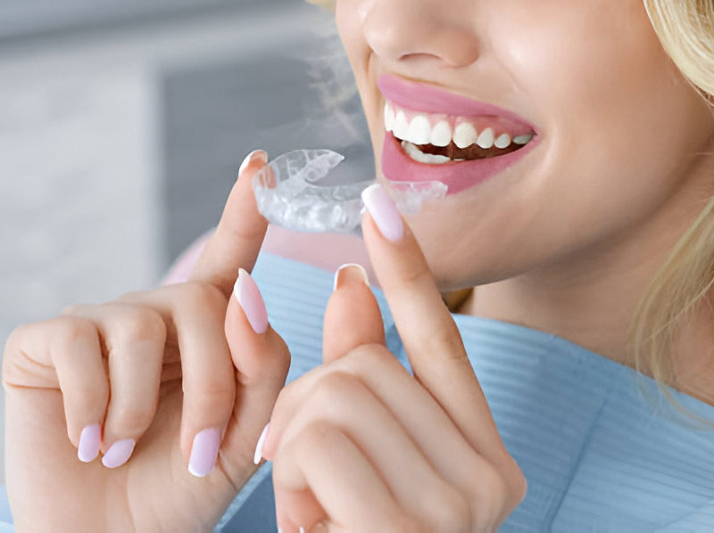 Best Aligners Treatment in Ahmedabad